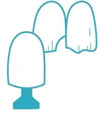 つめ物・かぶせ物