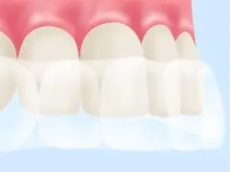 ホームホワイトニング